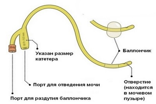 Уход за цистостомой. Строение мочевого катетера. Катетер Фолея схема установки. Надлобковый мочевой катетер Фолея. Схема установки мочевого катетера.