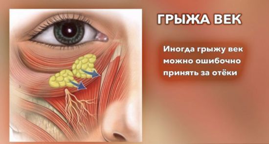 Лікарські методи лікування очної грижі