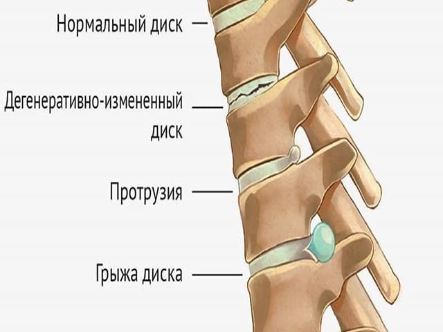 Грыжа диска l5. Диски l5-s1 в позвоночнике. Диск l5-s1. Диск л5 с1 межпозвоночный. Дисков l5 s1.